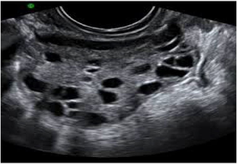 Ултразвукова диагностика на яйчниковия резерв