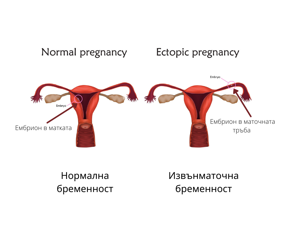 Извънматочна бременност при инвитро