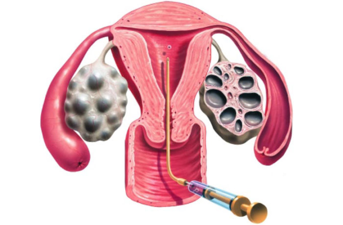 Трансфер на ембриони в матката